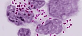 gonorrhea
