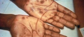 palmar-1